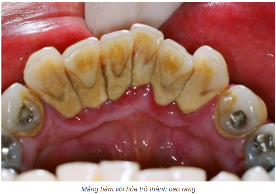 TÁC HẠI CỦA CAO RĂNG ẢNH HƯỞNG ĐẾN SỨC KHỎE RĂNG MIỆNG NHƯ THẾ NÀO ...