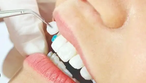 Bọc răng sứ có tháo ra được không?