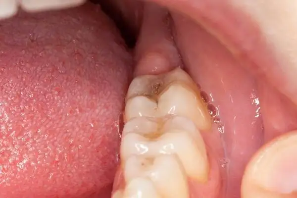 Áp xe răng khôn: Nguyên nhân, dấu hiệu, cách điều trị