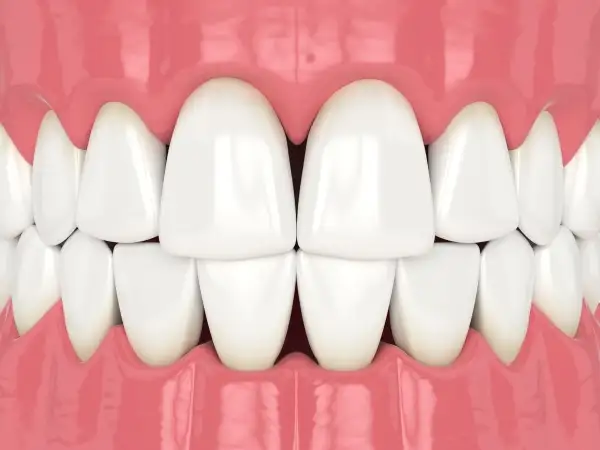 Vùng tam giác đen khi niềng răng: Nguyên nhân và giải pháp khắc phục