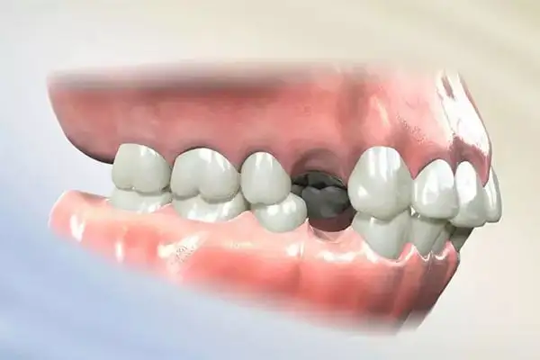 Những điều cần biết về răng số 4?