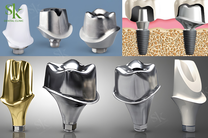 Hình ảnh minh họa Abutment