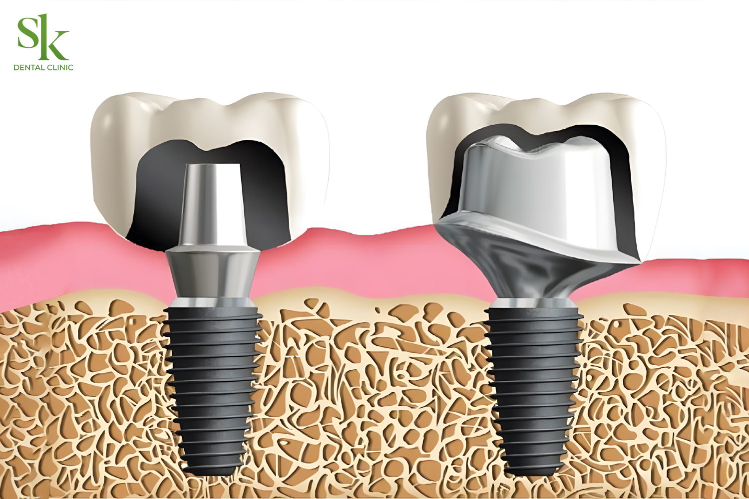 Abutment cá nhân giúp hỗ trợ mô nướu phát triển