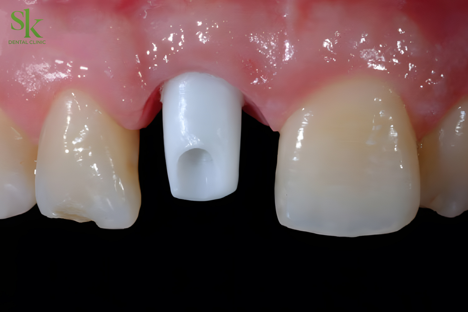 Abutment cá nhân đem lại thẩm mỹ vượt trội