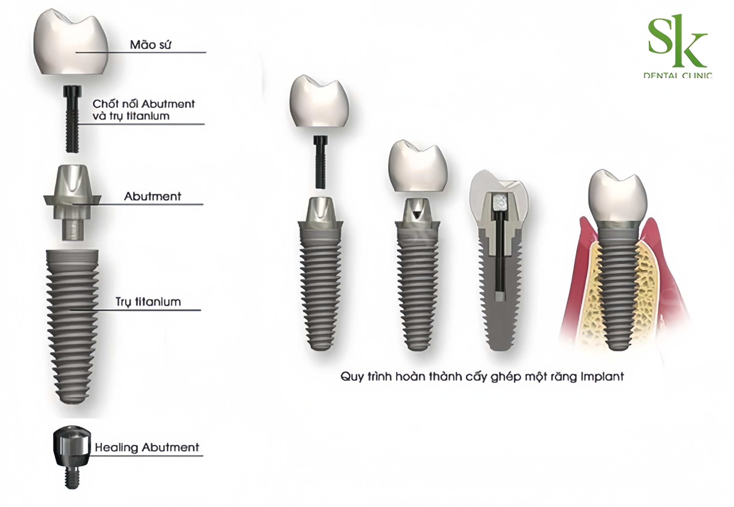 Abutment đóng vai trò cầu nối giữa trụ implant và mão răng