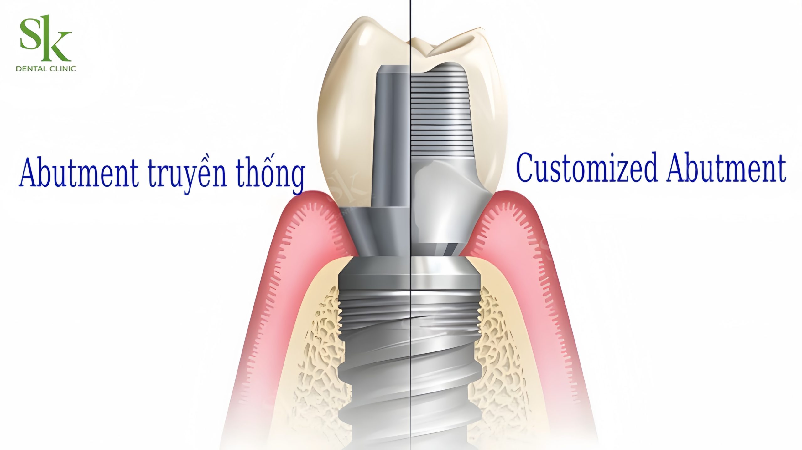 Abutment thông thường và Abutment cá nhân hóa