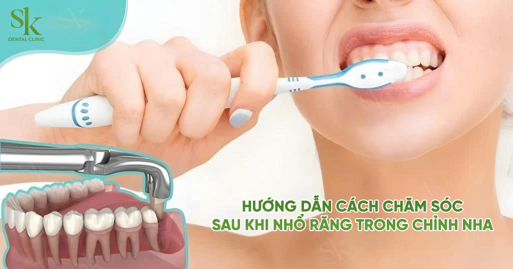 Hướng dẫn cách chăm sóc sau khi nhổ răng trong chỉnh nha
