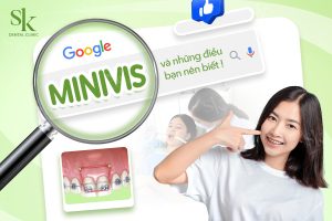 Cắm minivis niềng răng là gì?
