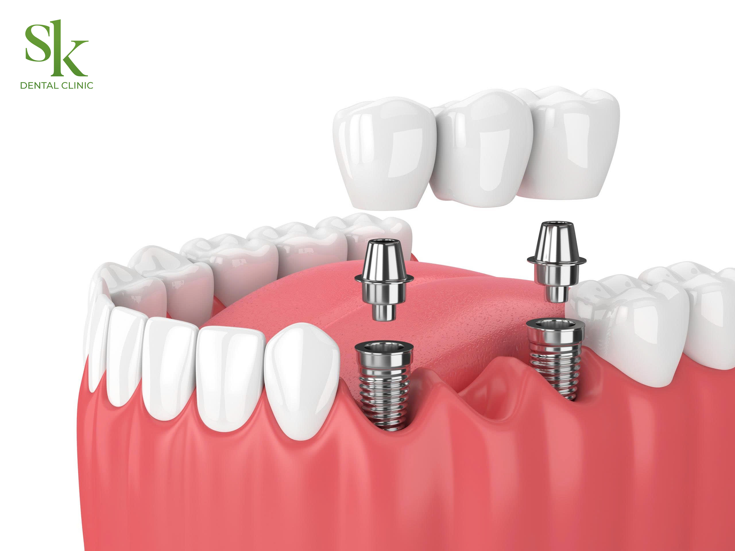 Cắm răng Implant