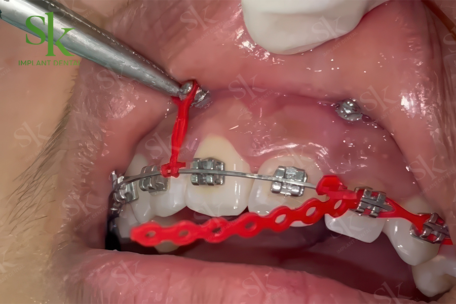 cắm minivis trong chỉnh nha