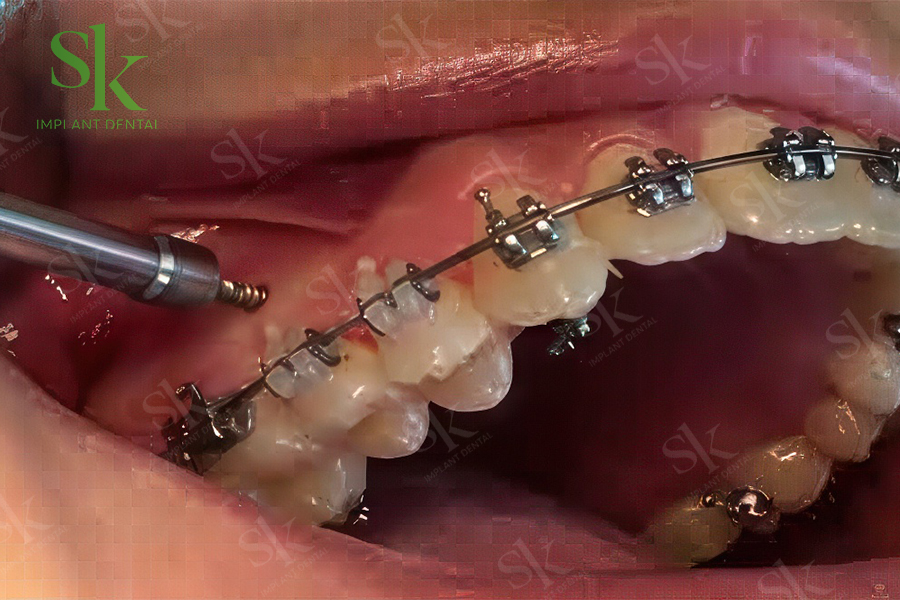 Quy trình cắm vís trong chỉnh nha