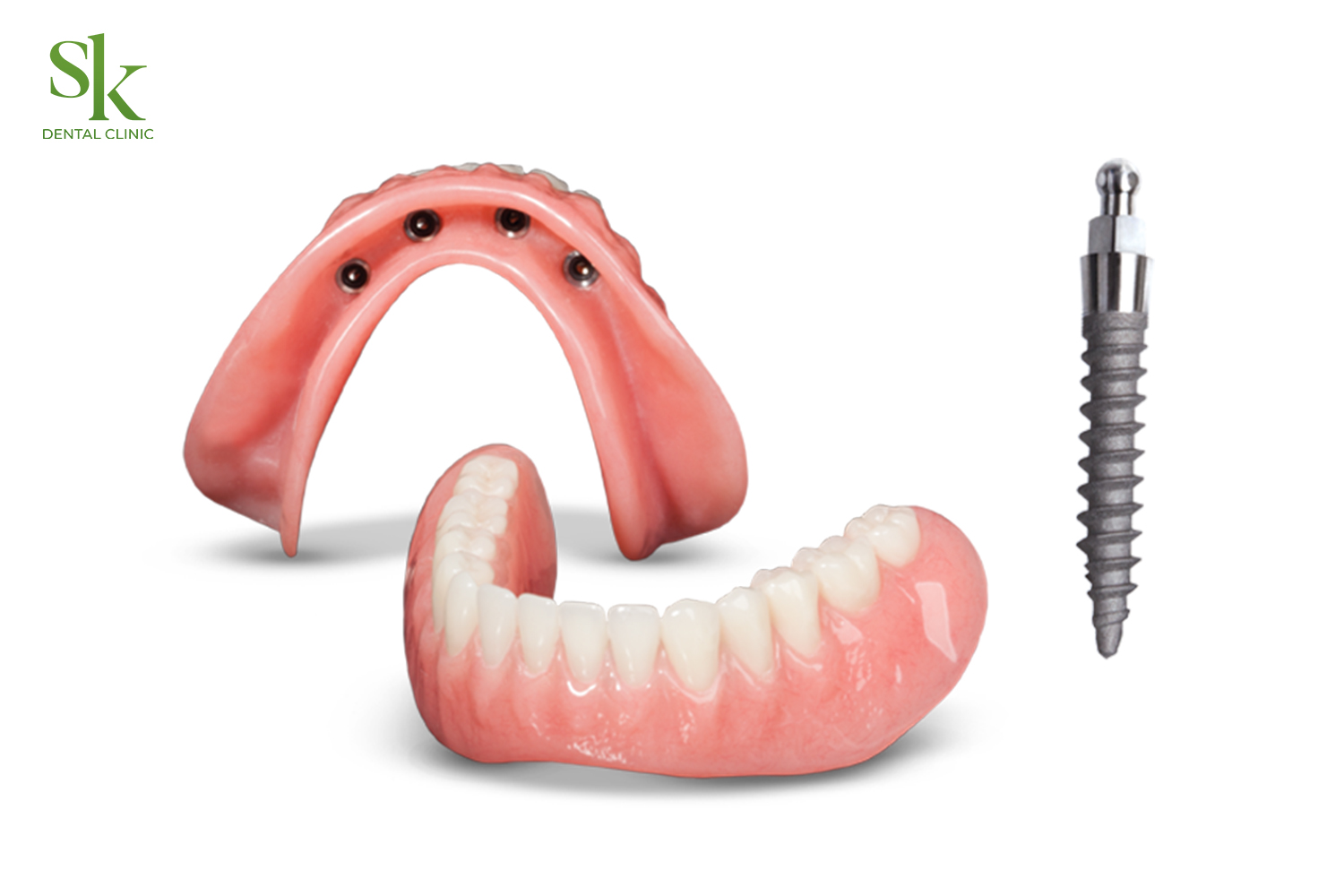 Cấy Implant mini
