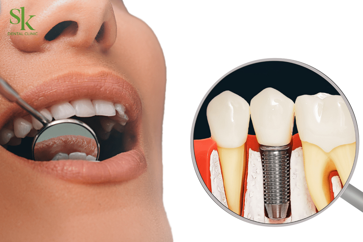 Cấy trồng răng Implant