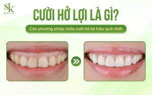 Chữa cười hở lợi