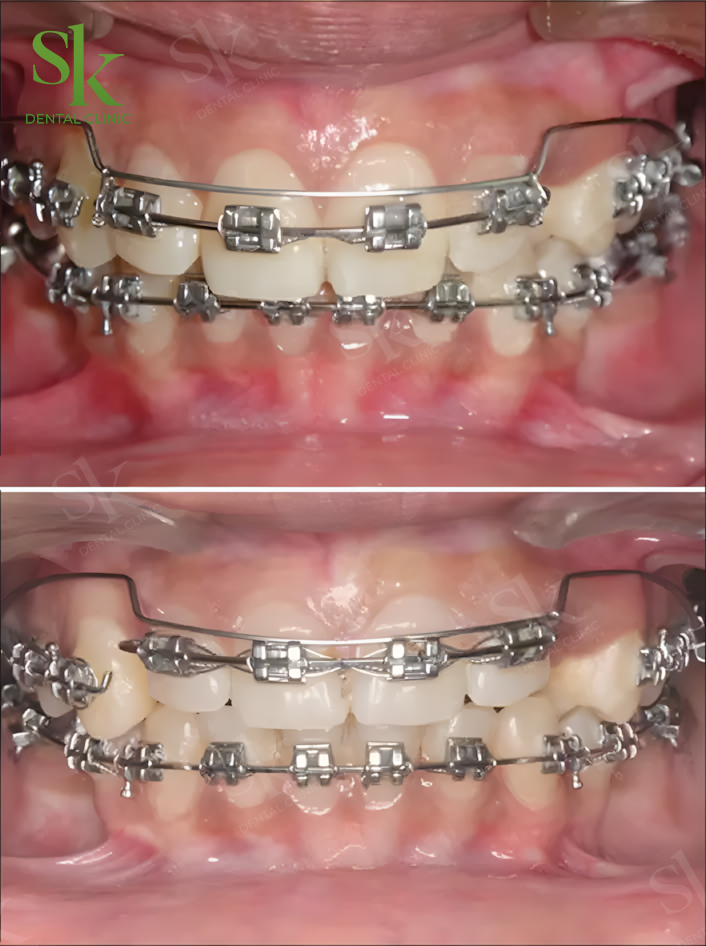 Đánh lún bằng mắc cài kết hợp dây cung đặc biệt
