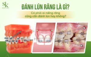 Đánh lún răng là gì?
