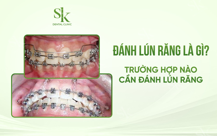 Các trường hợp chỉ định đánh lún răng