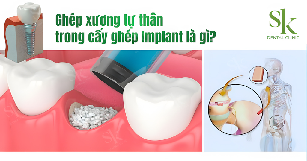 Ghép xương tự thân là gì?