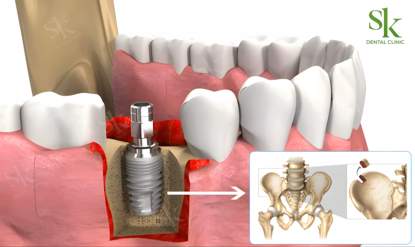 Ghép xương tự thân trong cấy ghép Implant