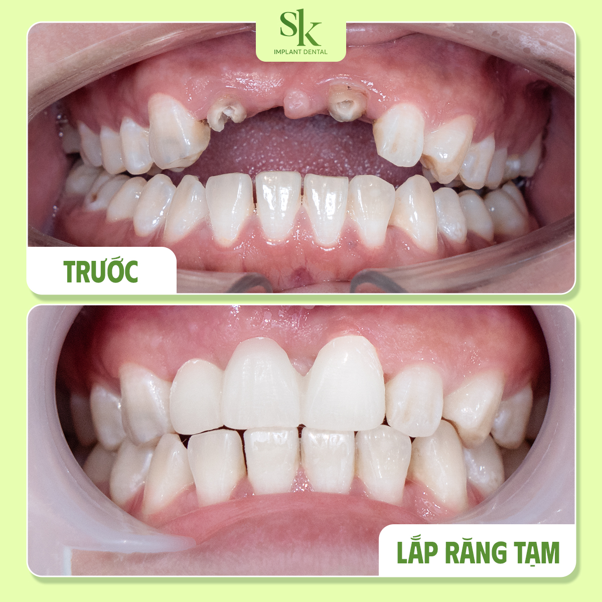 Khách hàng trồng Implant đơn lẻ