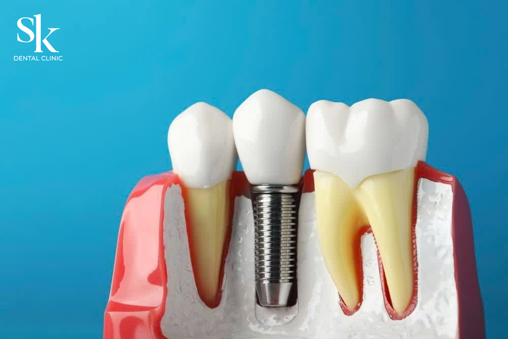Làm răng Implant