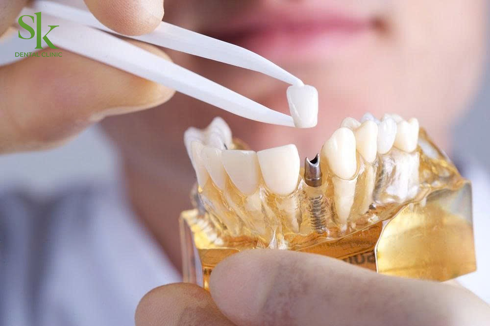 Gắn mão sứ phục hình khi trồng răng Implant