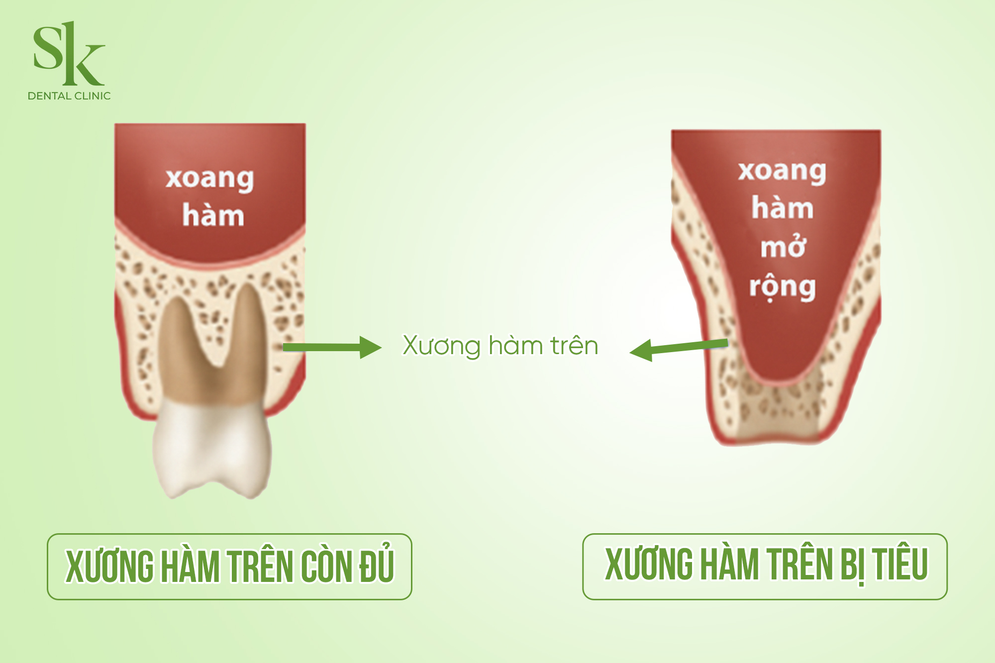 Trường hợp nên thực hiện nâng xoang cấy Implant