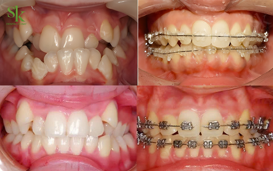 Nhổ Răng số 3 (răng nanh) khi niềng răng
