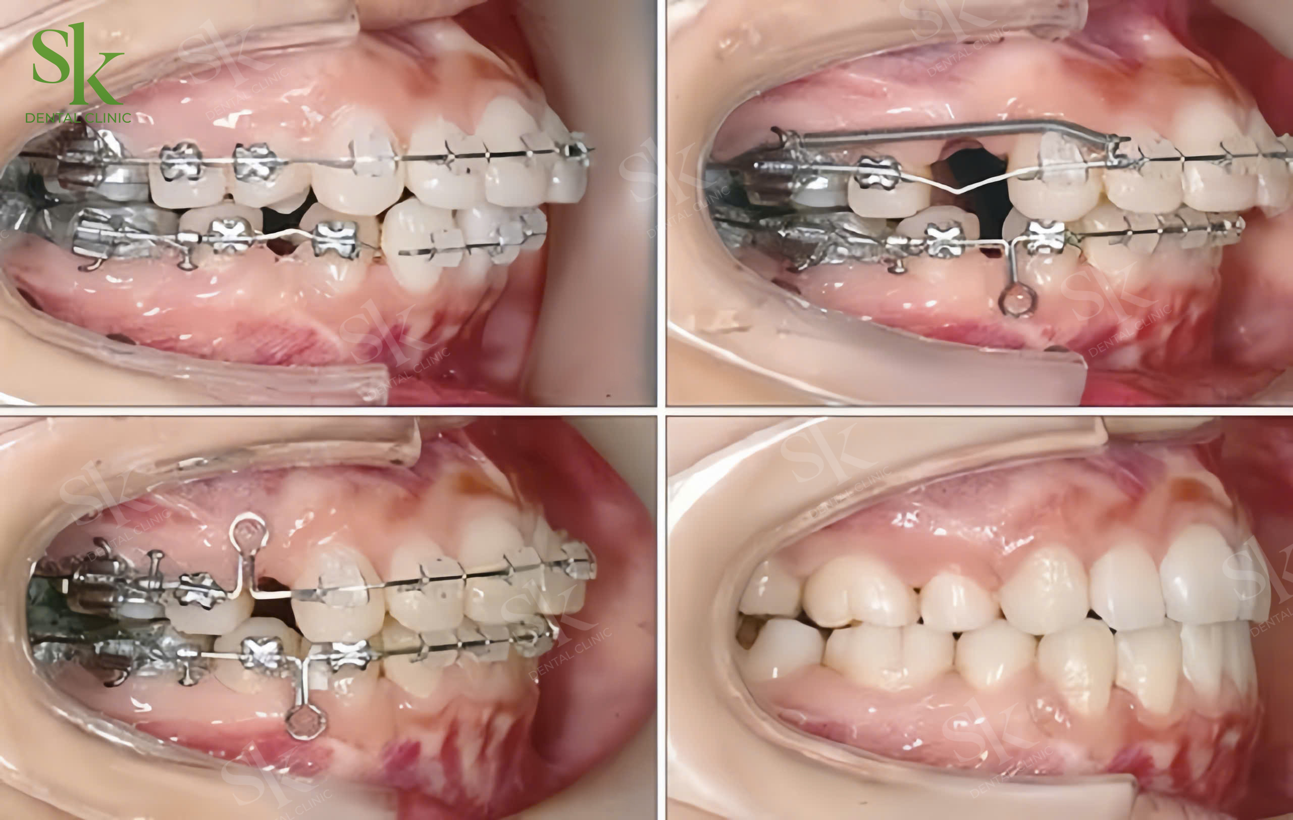 Nhổ Răng số 4 (răng cối nhỏ thứ nhất) khi niềng