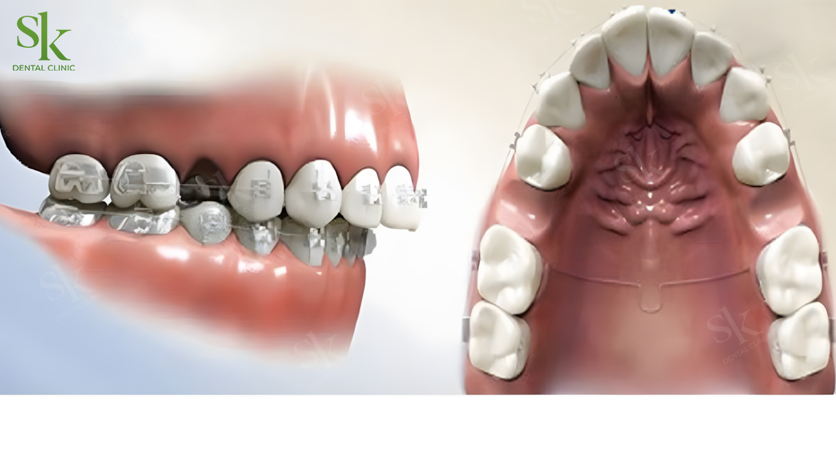 Nhổ Răng số 5 (răng cối nhỏ thứ hai) khi niềng