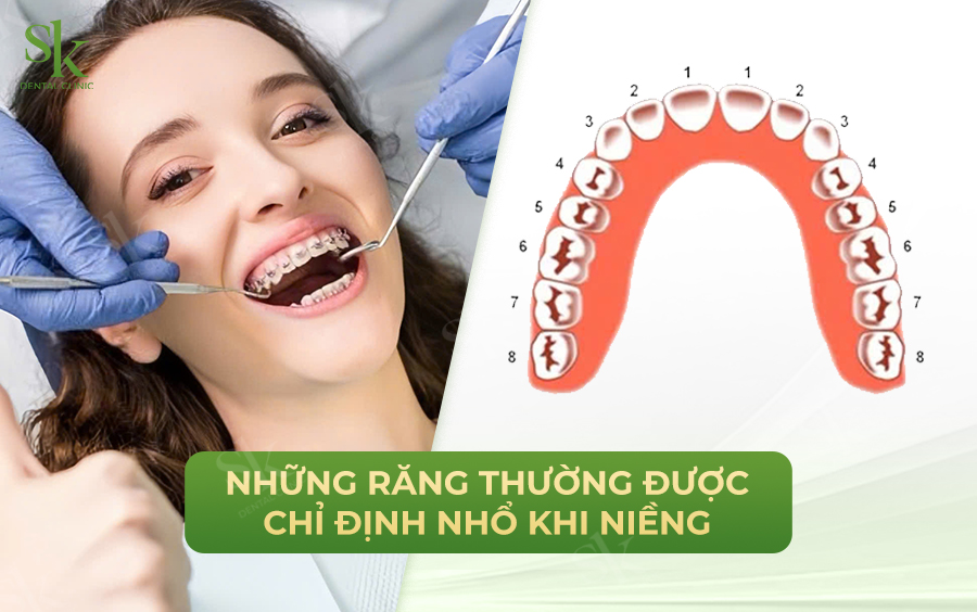 Những răng thường được chỉ định nhổ khi niềng