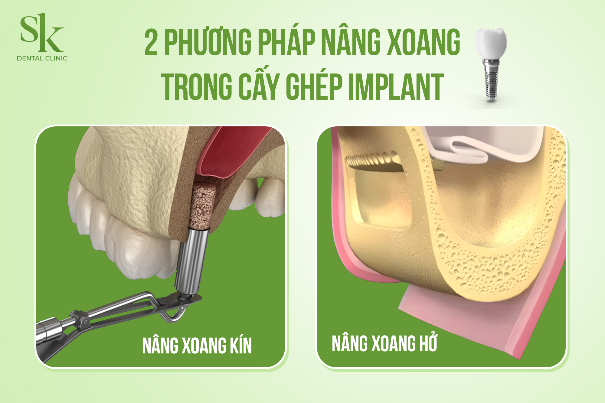 Phương pháp nâng xoang kín và nâng xoang hở