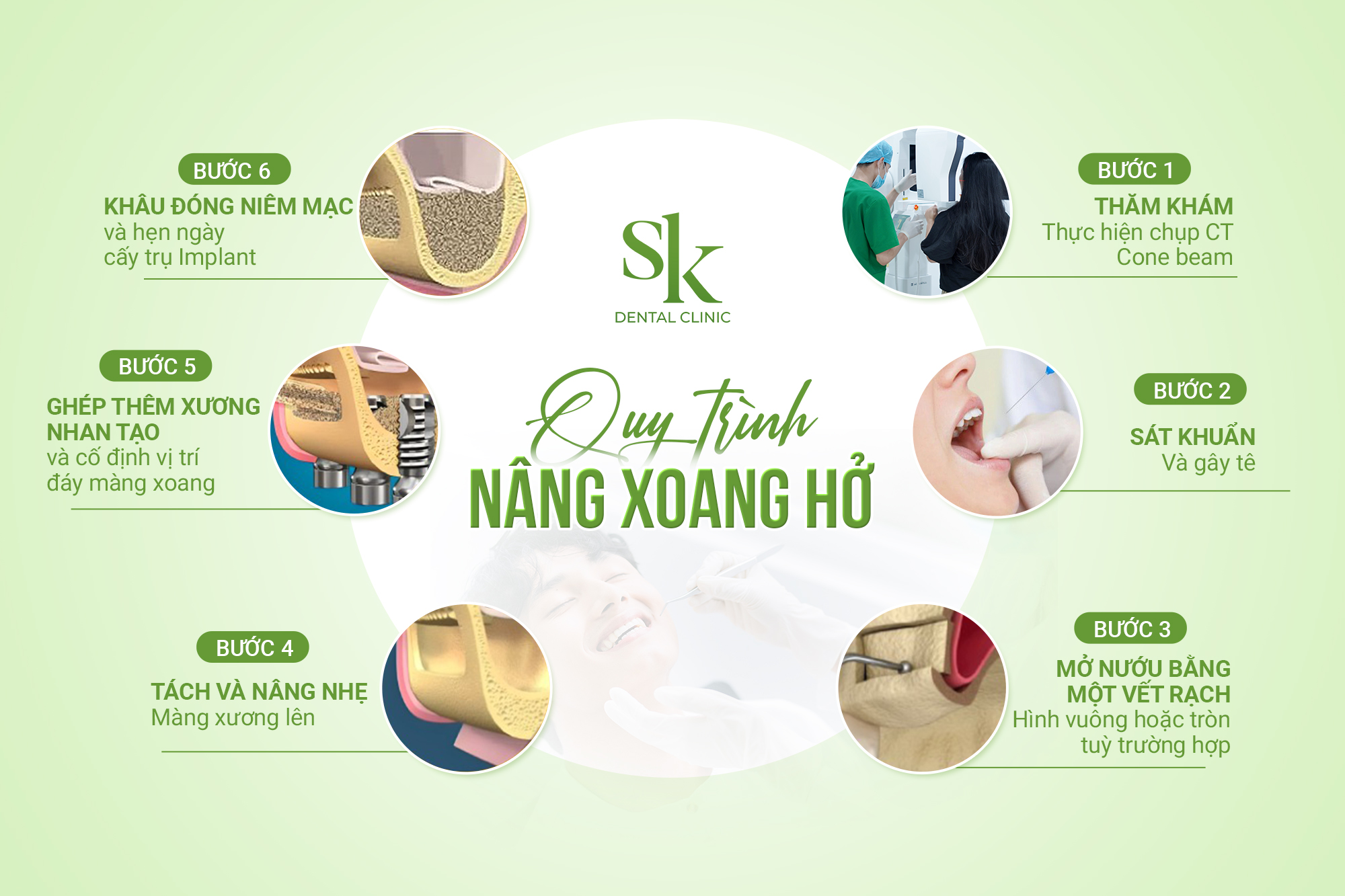 Quy trình nâng xoang hở