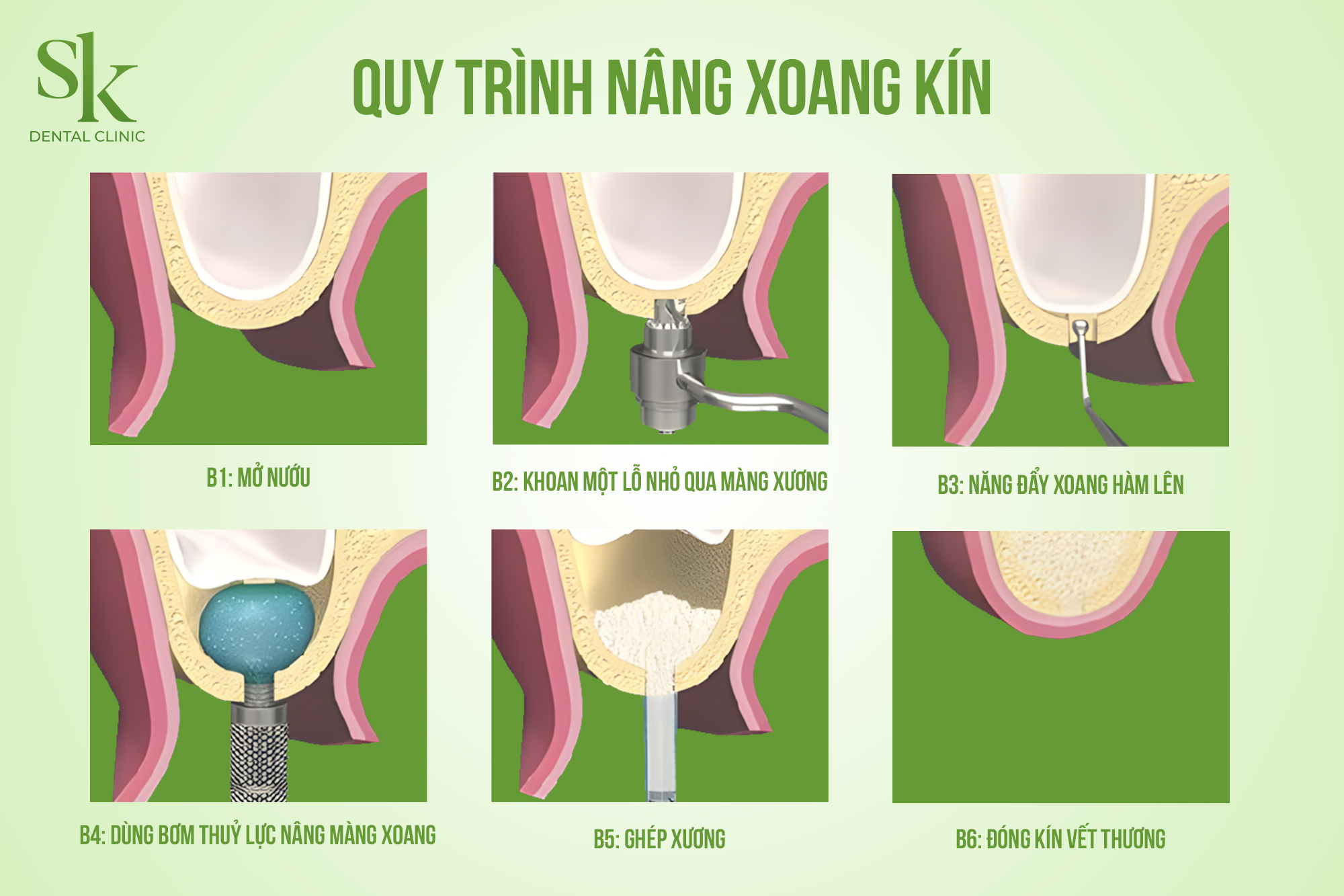 Quy trình nâng xoang kín