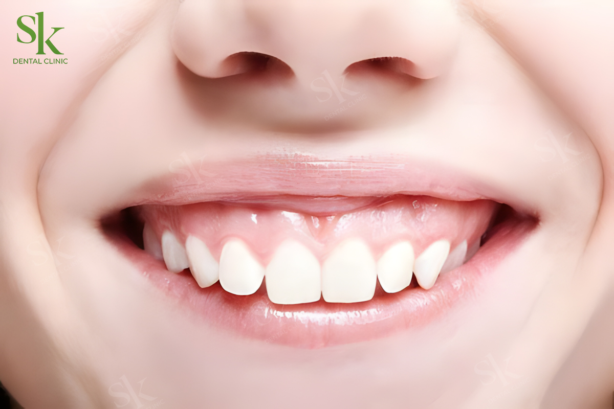Tình trạng cười hở lợi
