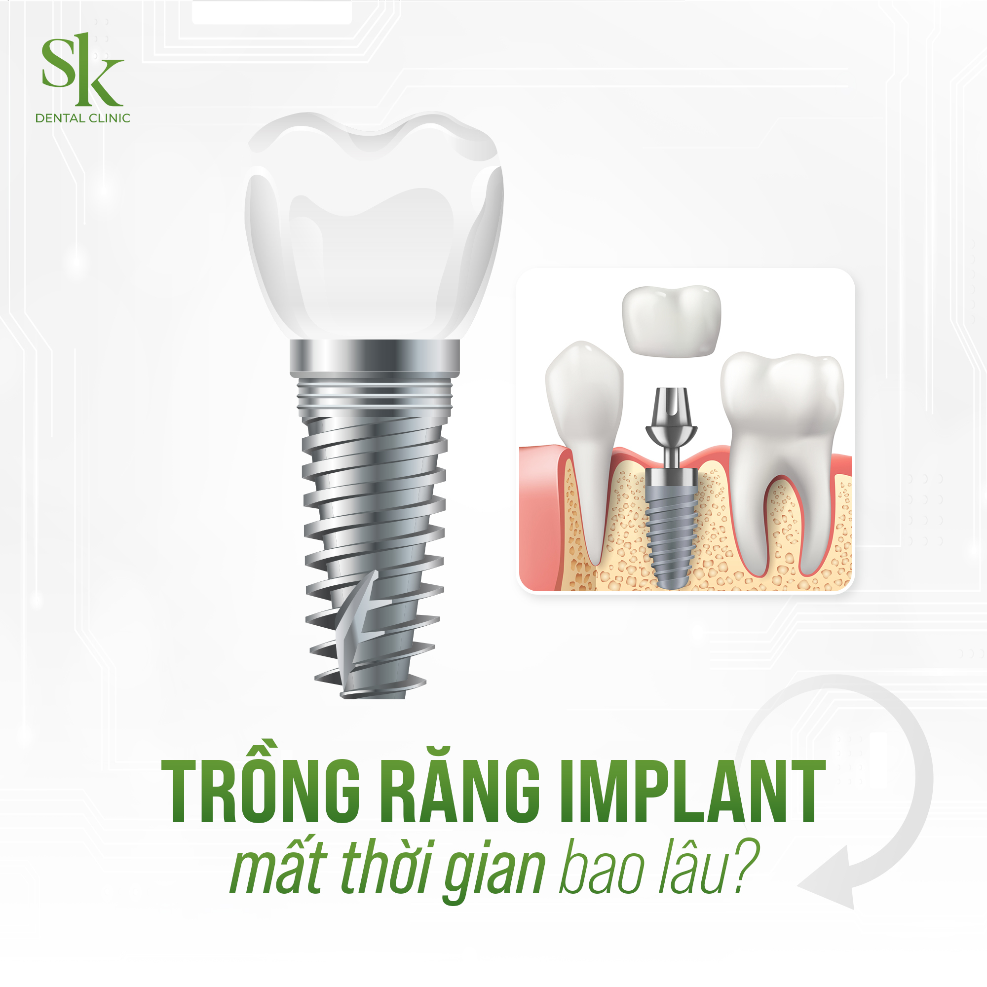 Trồng răng Implant mất thời gian bao lâu?