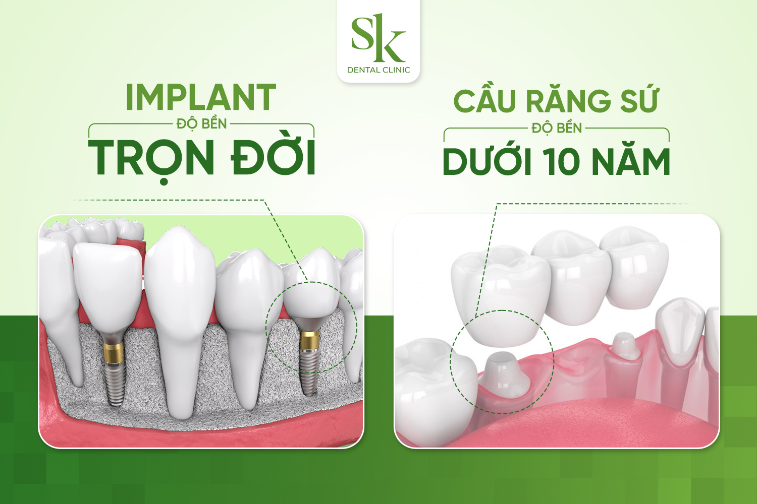 Trồng răng Implant và cầu răng sứ