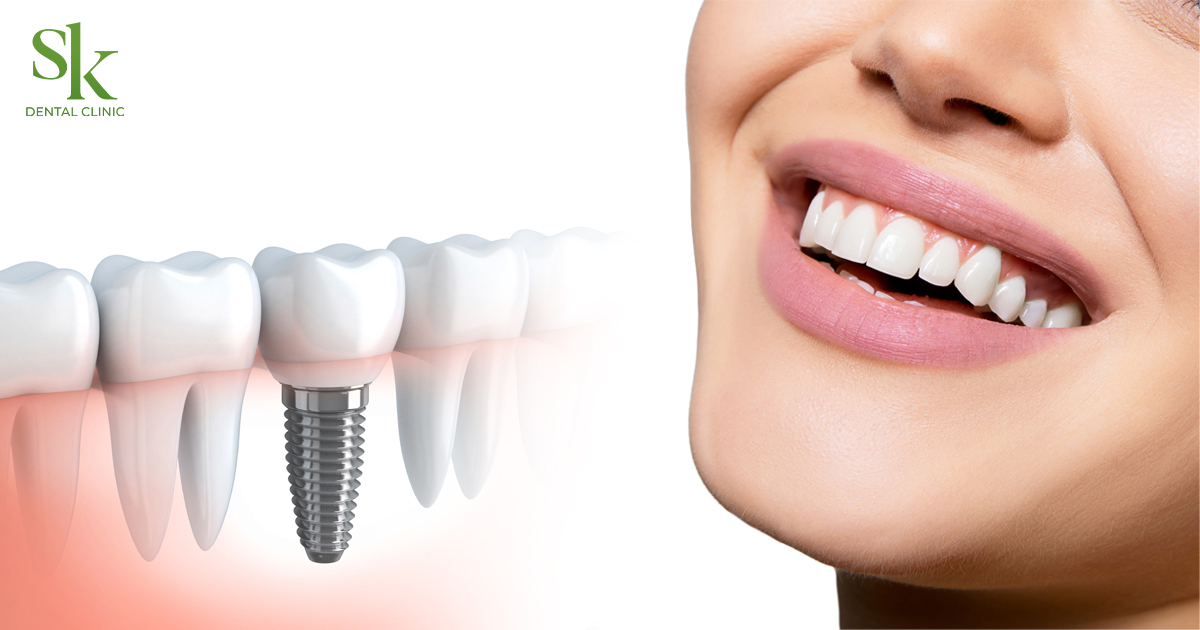 Cấy trồng răng Implant