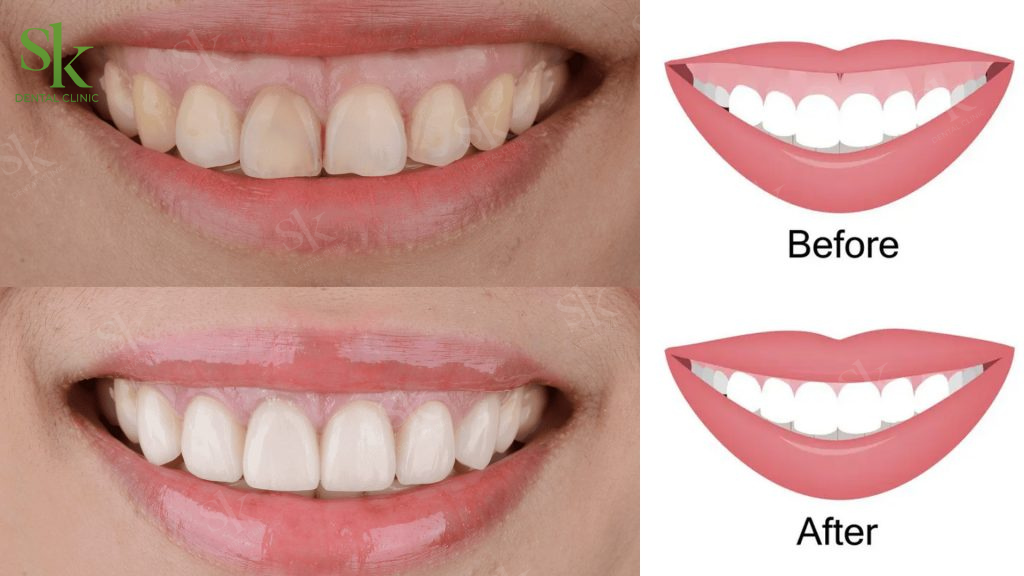 Trước và sau khi điều trị cười hở lợi