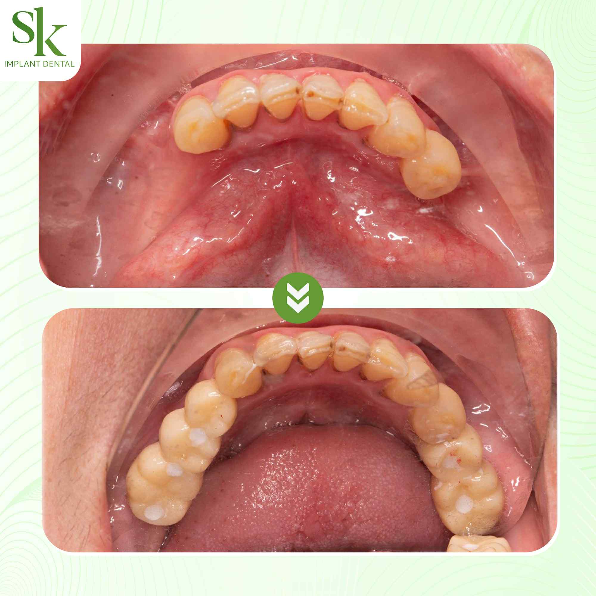 Khách hàng làm cầu răng trên Implant