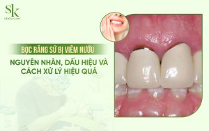 Bọc răng sứ bị viêm nướu