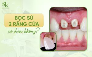 Bọc sứ 2 răng cửa được không?