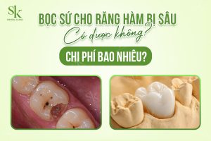 Bọc sứ cho răng hàm bị sâu