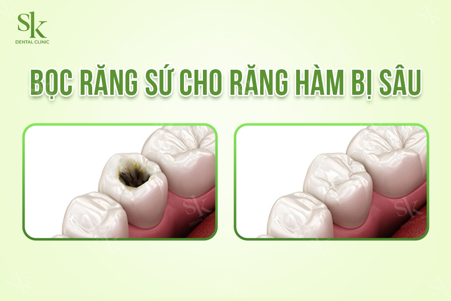 Bọc sứ răng hàm bị sâu
