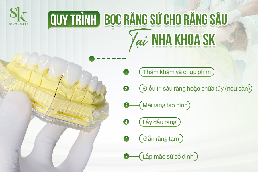 Quy trình bọc răng sứ cho răng sâu chuẩn y khoa tại Nha khoa SK