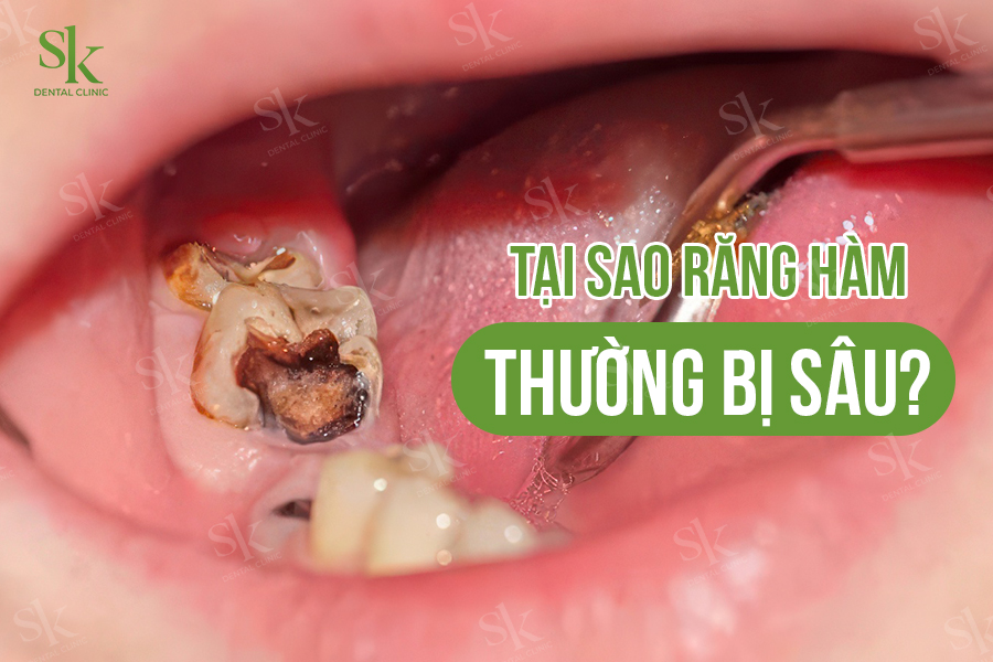 Răng hàm bị sâu