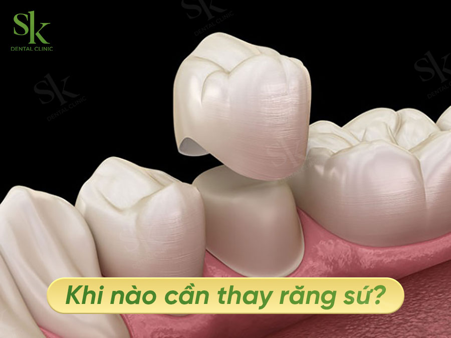 Khi nào cần thay răng sứ