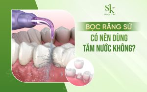 Bọc răng sứ có nên dùng tăm nước không