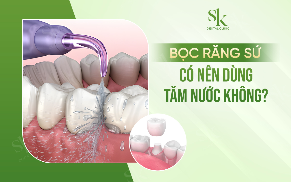 Bọc răng sứ có nên dùng tăm nước không