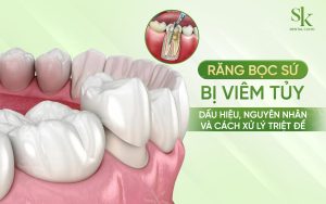 Răng bọc sứ bị viêm tuỷ